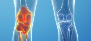 Efficacité incroyable de l’acupuncture pour la douleur du genou